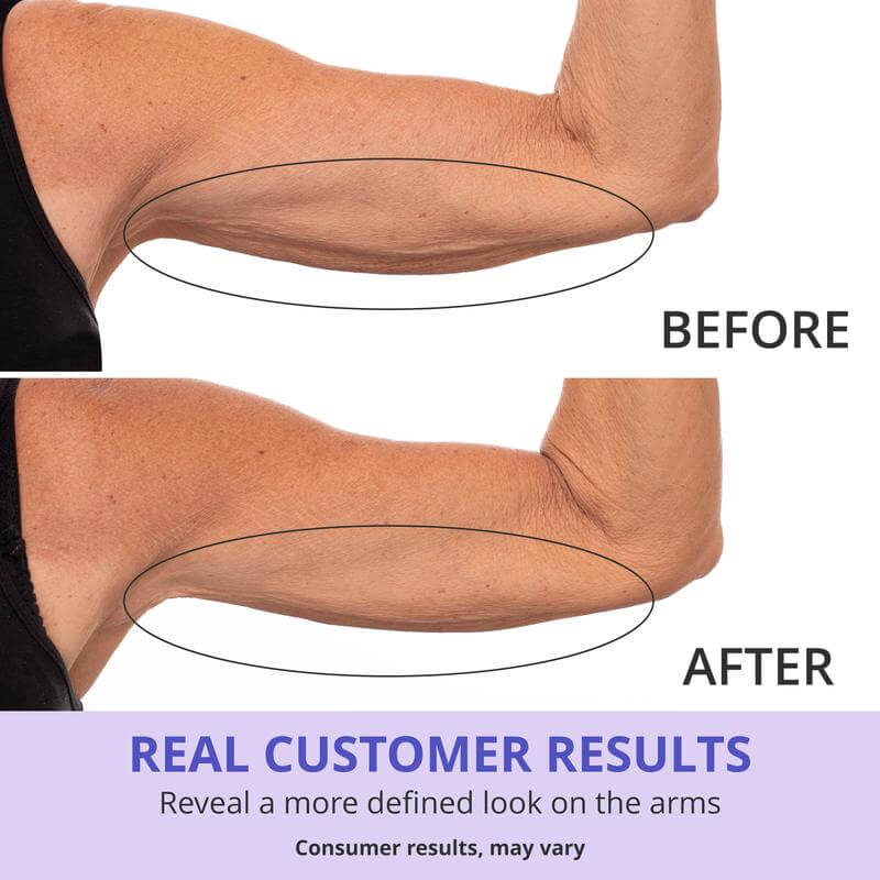 GOPURE™ | Reafirma cuello y brazos sin cirugía.